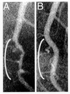 Koronar angiografi af yderste venstre forreste nedadgående arterie.